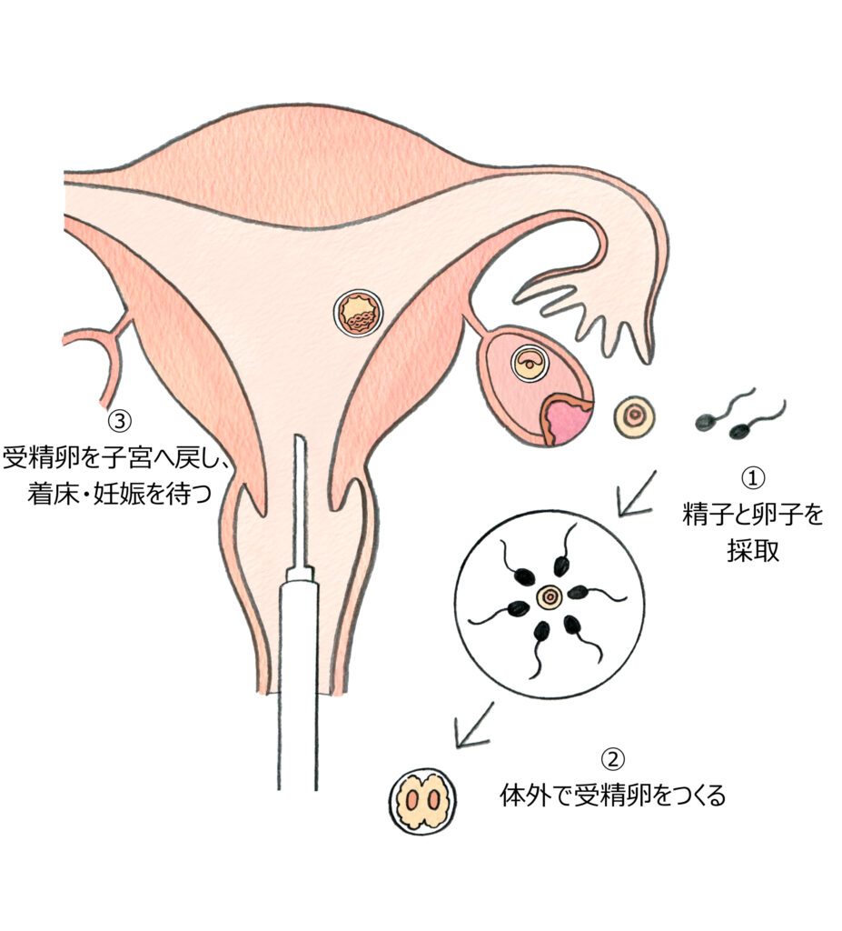 不妊治療とは 不妊治療オンライン