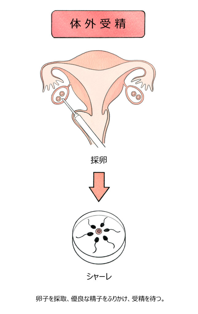 体外受精の流れ | 不妊治療オンライン